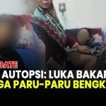 Polisi Kantongi Hasil Autopsi, Ada Luka Bakar Akibat Kekerasan